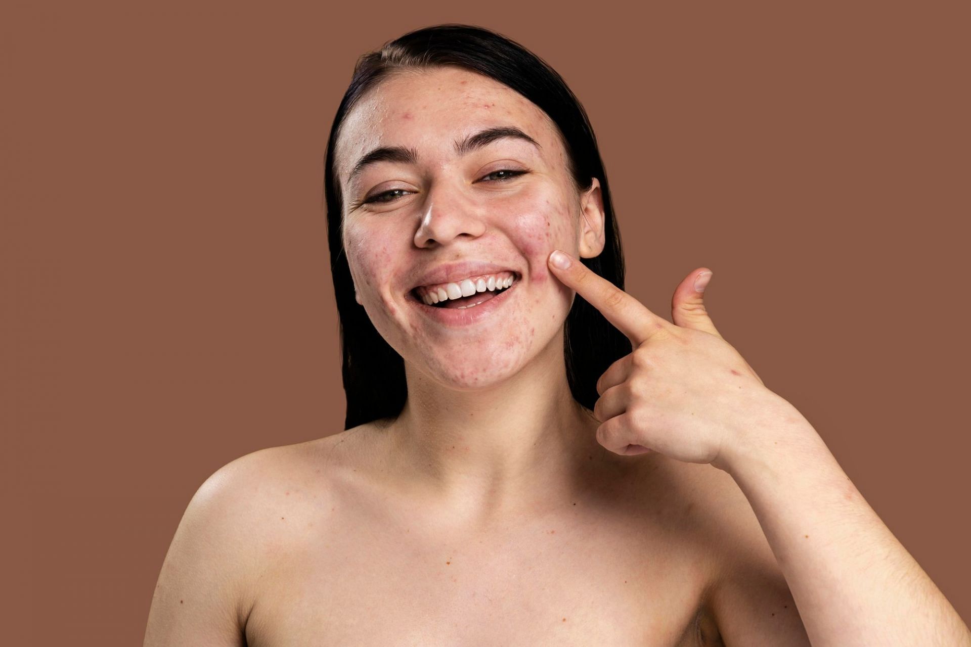 Ayurvedic Remedies for Acne (Image via Freepik)